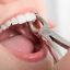 Dental-Extraction