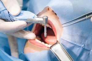 Dental-Surgery