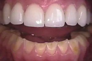 Full-Mouth-Rehabilitation