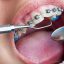 Orthodontic-Treatment-1