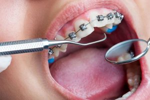 Orthodontic-Treatment
