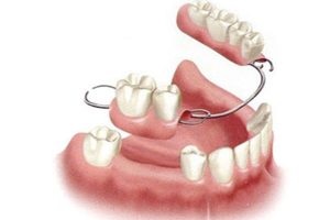 Removable-Partial-Denture
