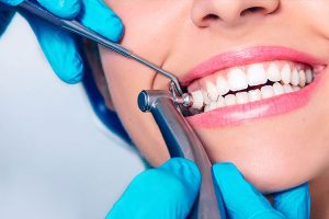 Scaling-Teeth-Cleaning-Polishing