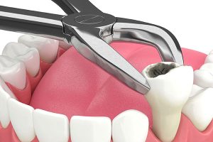 Tooth-Extraction